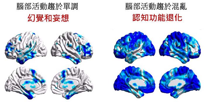 腦子亂了:思覺失調症致病機轉新發現