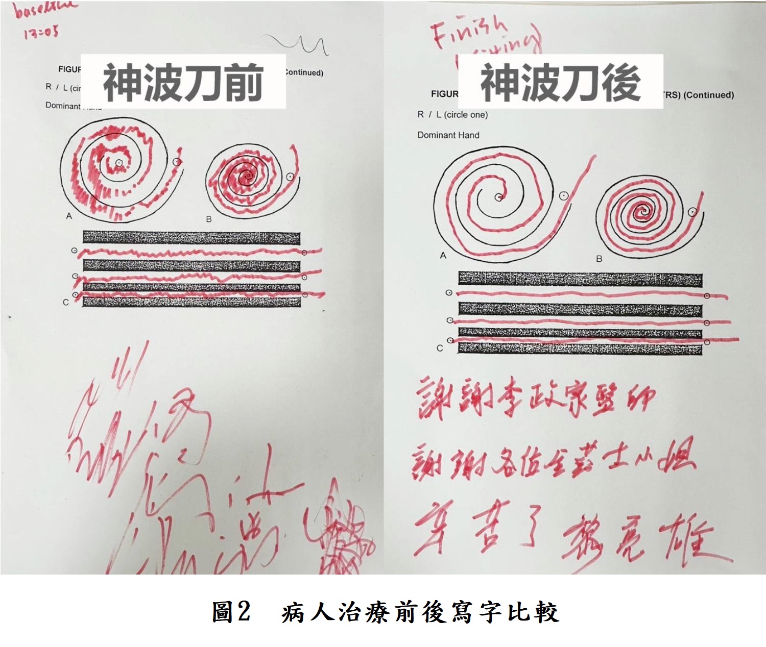 圖2 病人治療前後寫字比較