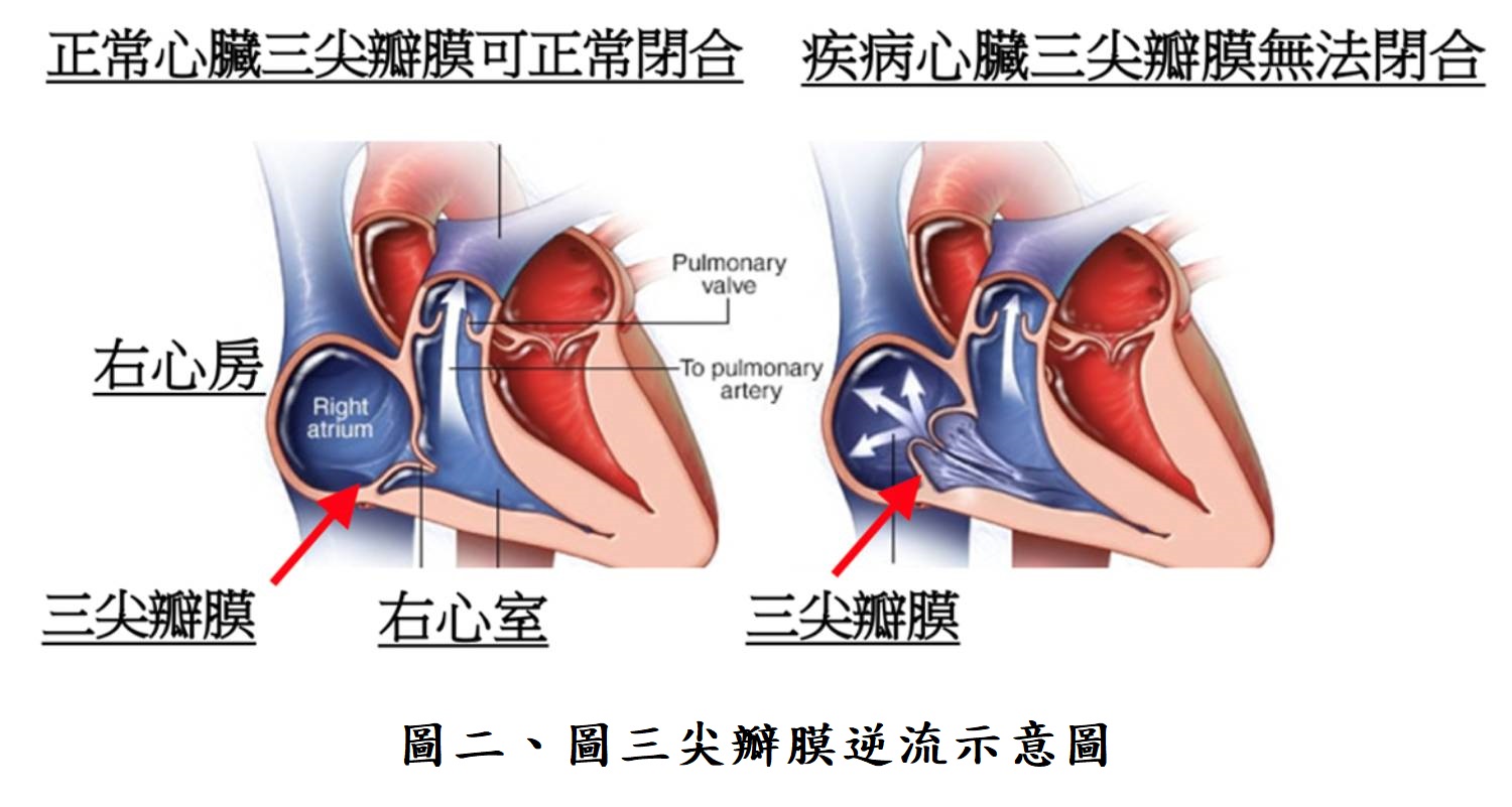 圖二、圖三尖瓣膜逆流示意圖